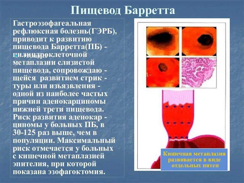 Пищевод барретта рекомендации. Желудочная цилиндроклеточная метаплазия пищевода. Толстокишечная метаплазия пищевода Барретта. Гастроэзофагеальная рефлюксная болезнь патанатомия. Метаплазия эпителия пищевода.