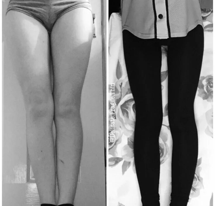 Thigh gap. Тонкие стройные ноги. Худые ноги. Ноги с просветом. Худые тонкие ноги.