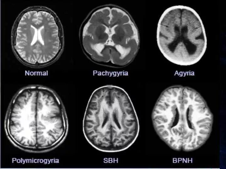 Аномалии развития нерва. Лиссэнцефалия-пахигирия. Врожденные аномалии головного мозга. Аномалия развития ЦНС мрт. Пороки развития головного мозга у плода.