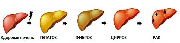 Жировое увеличение печени. Неалкогольный жировой гепатоз печени. Жировой гепатоз 1 степени. Жировой гепатоз 3 степени. Неалкогольная жировая болезнь печени стадии.