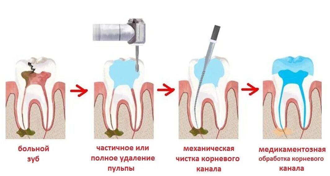 Пульпит 2 канального зуба. Корневой канал при воспалении пульпы пломбируют.
