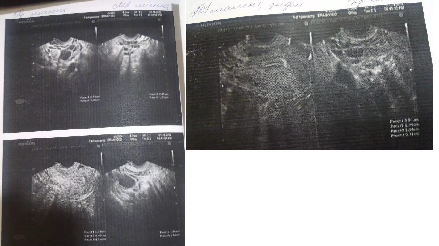Климакс на узи. М-Эхо 14 мм линейный. М-Эхо 9.6мм. М-Эхо матки 12мм.