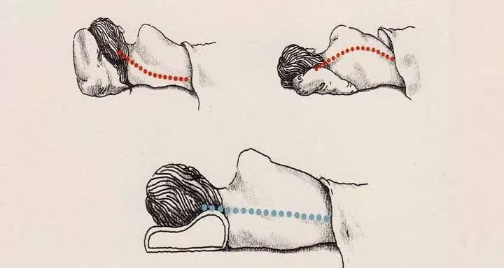 Почему спят без подушки. Спать без подушки. Спать без подушки при шейном остеохондрозе. Остеохондроз шейного отдела подушка. Что если спать без подушки.