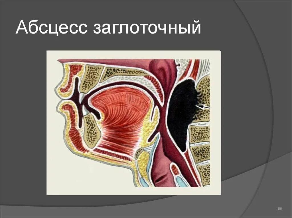 Правосторонний гнойный. Ретрофарингеальный абсцесс. Перитонзиллярный абсцесс. Абсцесс заглоточного пространства. Внутриминдаликовый абсцесс.