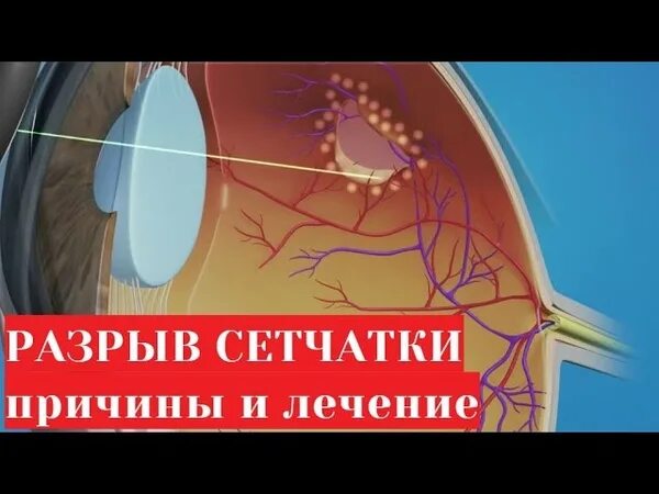 Лазеркоагуляция сетчатки глаза. Отслойка сетчатки макулярный разрыв. Лазерная коагуляция сетчатки глаза. Лазерный операция глаза разрыв сетчатки.