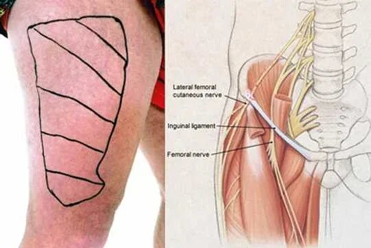 Невропатия наружного кожного нерва бедра (болезнь рота). Синдром рота. Парастетическая ноталгия. Неврит латерального кожного нерва бедра. Миалгия.