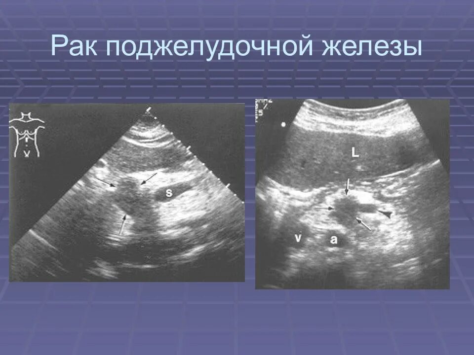 Опухоль головки поджелудочной железы УЗИ признаки. Ракьподжелудочной железы. Образования поджелудочной железы на УЗИ. Опухоль поджелудочной железы на УЗИ.