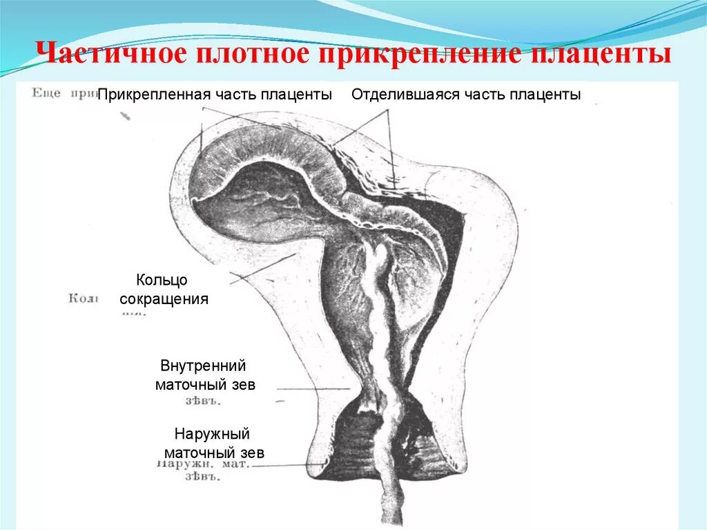 Истинное приращение. Неполное плотное прикрепление плаценты. Плотное прикрепление и приращение плаценты. Платное прикрепление плаценты. Частичное плотное прикрепление плаценты.