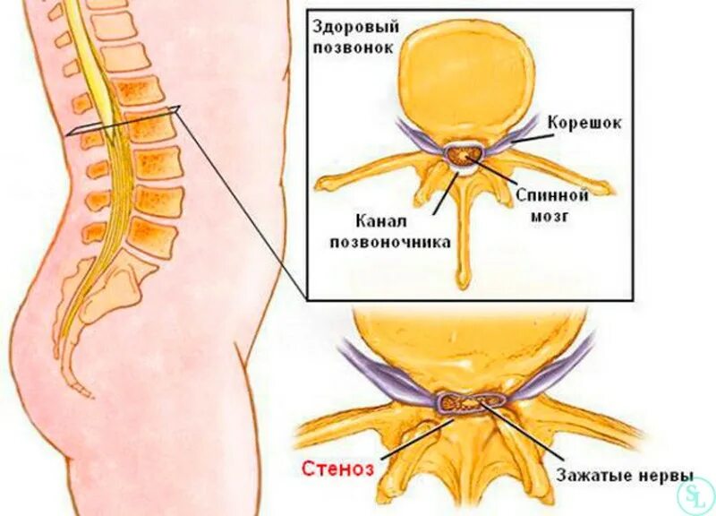 Поясничный абсолютный стеноз