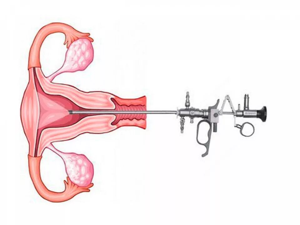 Гистерорезектоскопия полипа матки. Резектоскопия полипа эндометрия. Операция гистерорезектоскопия полипа эндометрия. Синдром Ашермана гистероскопия. Операции матки и трубы