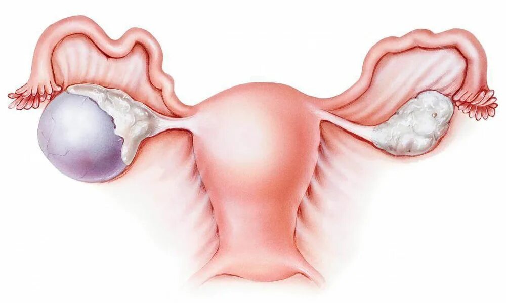 Сильная боль в матке. Дермоидная киста яичника. Эндометриоидные кисты яичника. Муцинозная киста яичника. Параовариальная киста яичника.