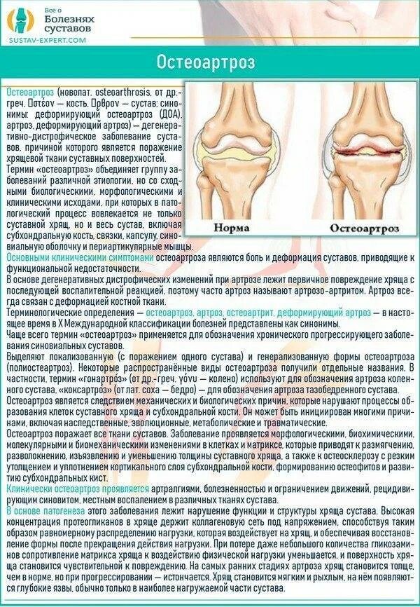 Питание при гонартрозе коленного сустава 2. Болезнь суставов остеоартроз. Поражение суставов при остеоартрозе. Артроз коленного сустава 2 степени диагноз.