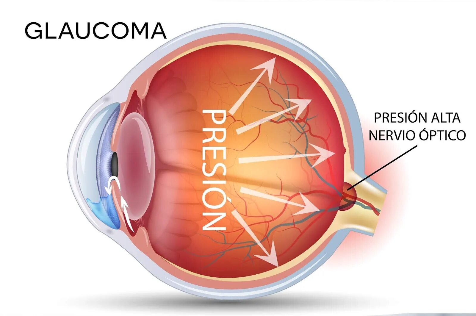 Глаукома причины возникновения. Посттравматическая глаукома. Глаукома латынь