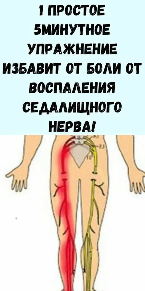 Седалищный нерв где он находится. Воспаление сидалищногонерва. восралениетседальщного нерва. седалищный нерв. воспаление седалищного нерва.