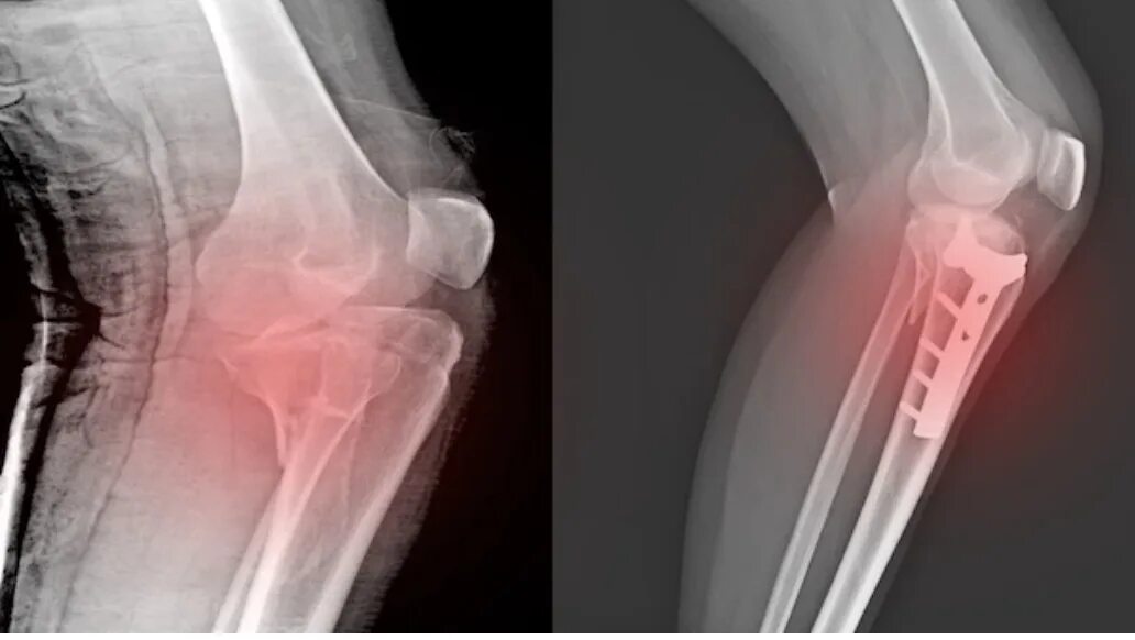 Перелом коленной чашечки рентген. Перипротезный перелом коленного сустава. Перелом надколенной кости. Перелом бугристости большеберцовой кости.