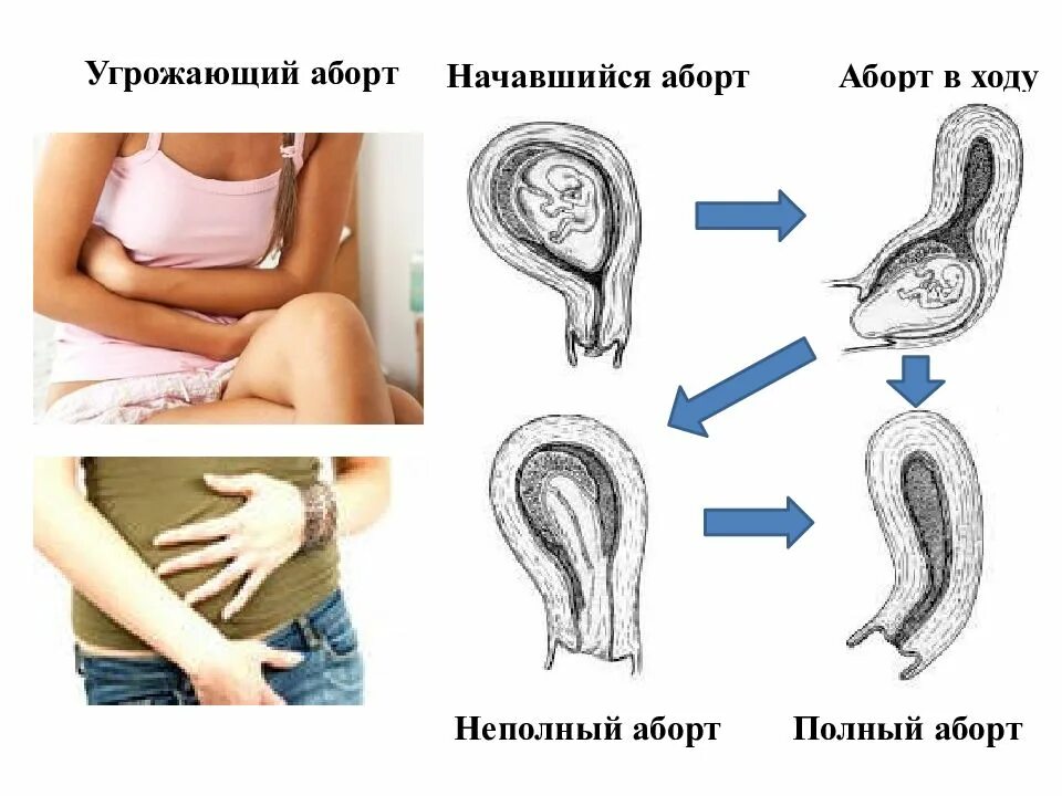 Беременность после самопроизвольного. Полный самопроизвольный аборт. Угрожающий самопроизвольный аборт. Неполный самопроизвольный аборт. Стадии самопроизвольного выкидыша.