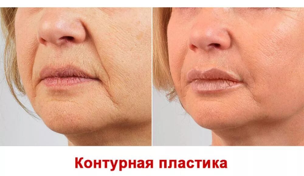 химические пилинги для лица до после. Clear lift лазерное омоложение. глубокий пилинг до и после. глубокое омоложение лица. глубокий химический пилинг.
