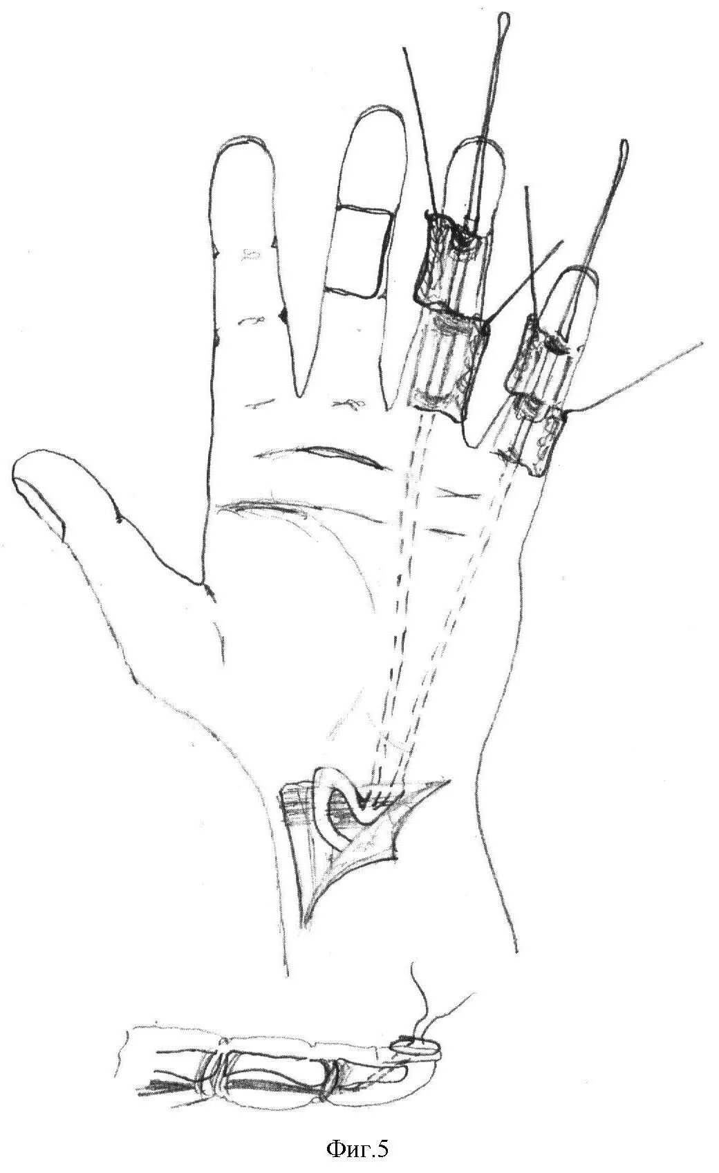 сухожилие сгибателя пальца анатомия. пластика сухожилий сгибателей. тендопластика сухожилий сгибателей пальцев кисти. пластика сухожилия сгибателя 1 пальца кисти. пластика сухожилий сгибателей.