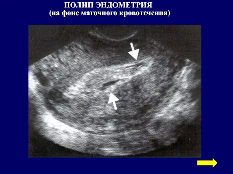 Железистый полип эндометрия на УЗИ. Полип эндометрия в матке на УЗИ. Аденоматозные полипы эндометрия. Аденоматозный полип эндометрия УЗИ. Медикаментозный эндометрий