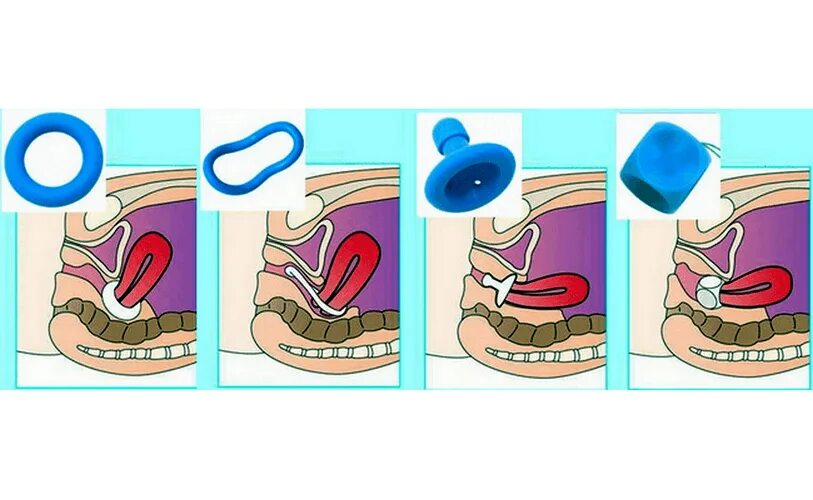 Urinary Incontinence in Women: Evaluation and Management AAFP