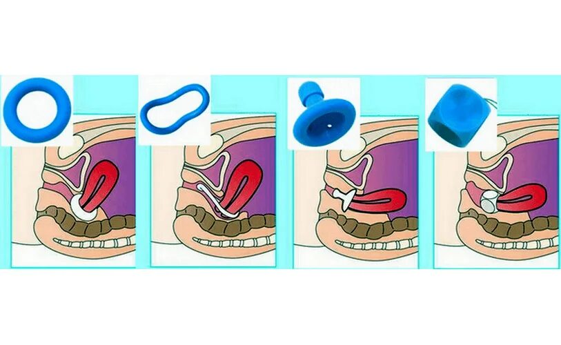 Акушерский пессарий короткая шейка матки. Писари акушерский пессарий. Кольцо на шейку матки при беременности. Пессарии установка схема. Как ставят пессарий при беременности