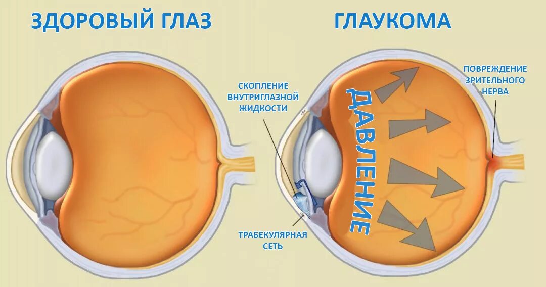 Глаукома офтальмология. Здоровый глаз и глаукома.