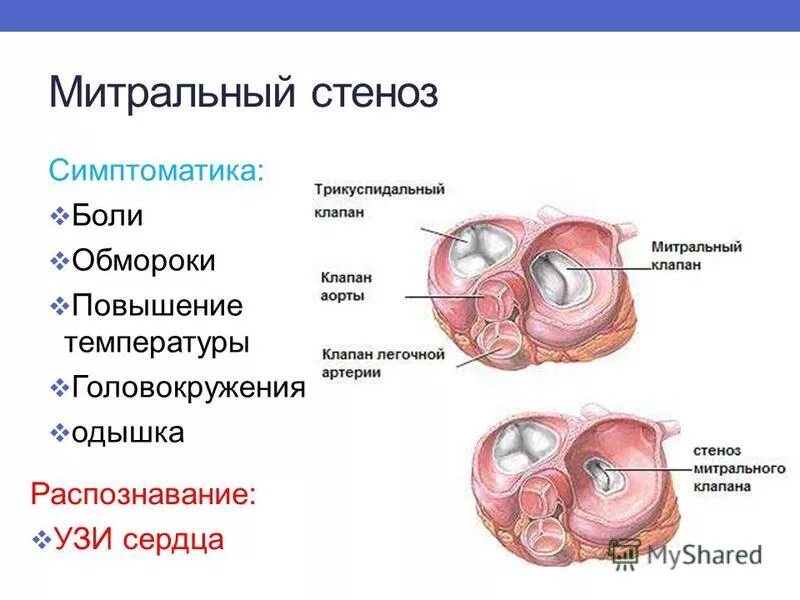 Митральный аортальный стеноз. Порок митрального клапана сердца. Пороки сердца митральный стеноз. Стеноз митрального клапана. Ревматический митральный стеноз.