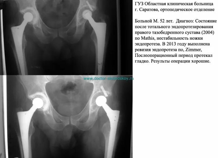 Нестабильность эндопротеза тазобедренного сустава кт. Ревизия тазобедренного эндопротеза. Ревизионное эндопротезирование правого тазобедренного сустава. Срок службы эндопротеза тазобедренного сустава.