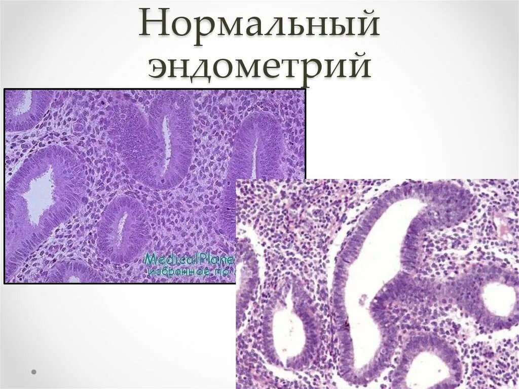 Гиперплазия эндометрия гистология. Нормальная гистология эндометрия. Эндометрий гистология норма. Пререцептивный эндометрий.