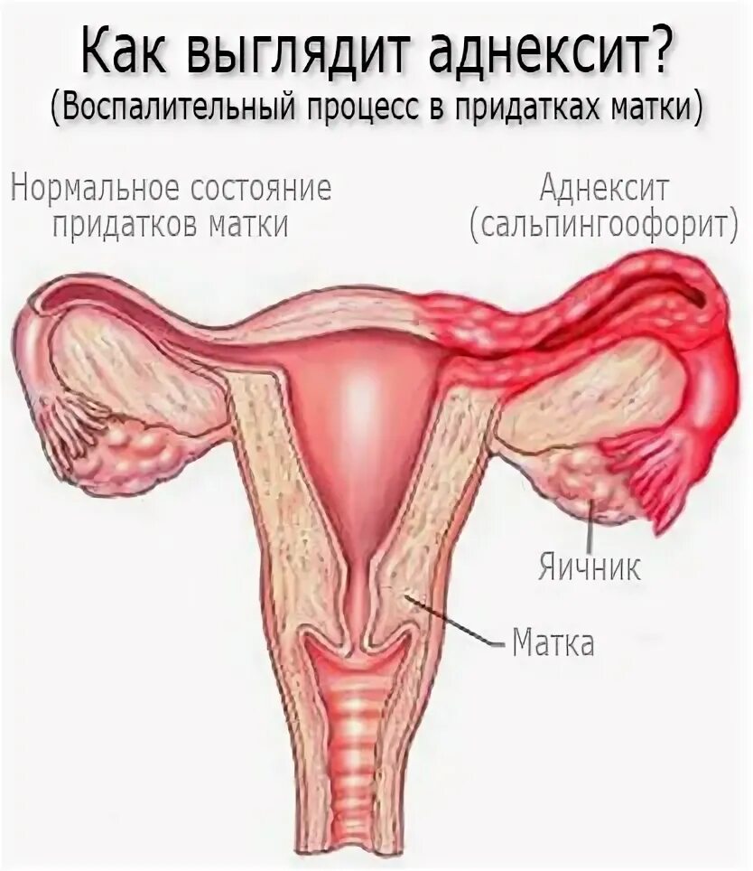 Сальпингоофорит (аднексит). Аднексид