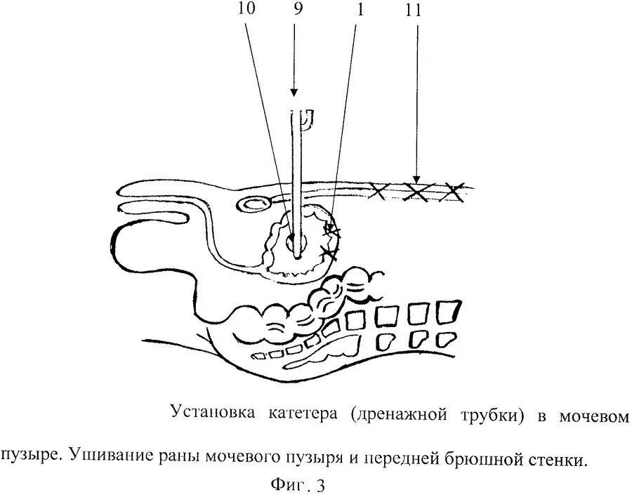 После удаления мочевого пузыря у мужчины. Цистостома мочевого пузыря катетер. Дренирование мочевого пузыря. Выведение трубки из мочевого пузыря.