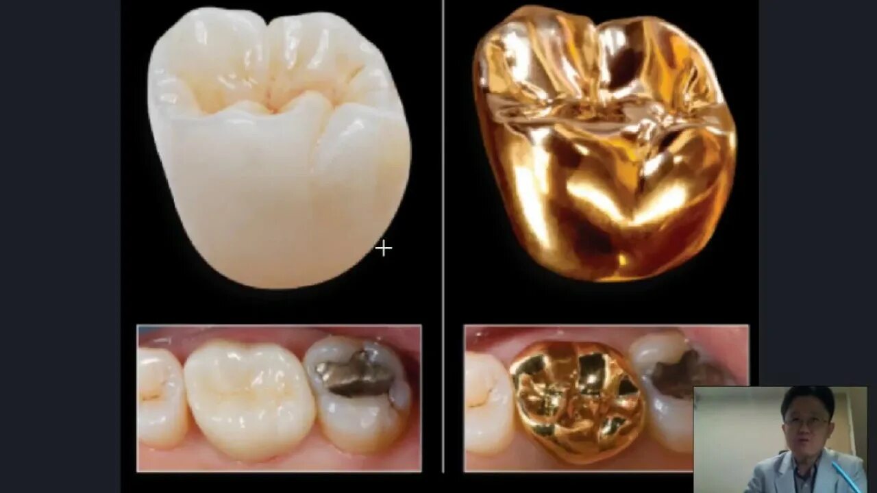 Коронки из каких материалов бывают. Металлические коронки на жевательные зубы. Коронки для жевательных зубов. Металлокерамическая коронка.