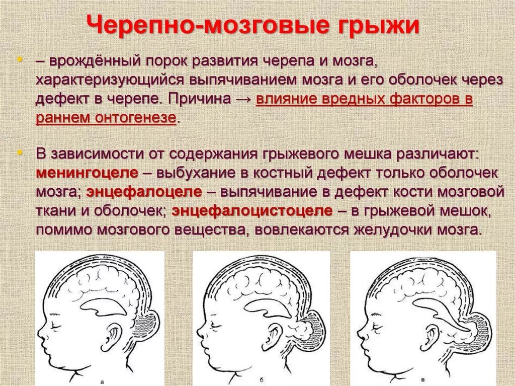 Черепная аномалия. Врожденные черепно мозговые грыжи. Черешня мозговая грыжа. Аномалии развития мозга. Пороки развития черепа и головного мозга.