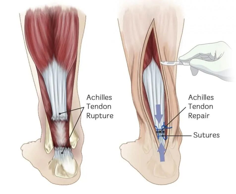 Почему постоянно рвется. Частичный разрыв связок ахиллова сухожилия. Иннервация ахиллова сухожилия. Тендинит ахиллова сухожилия. Порванные связки ахиллова сухожилия.