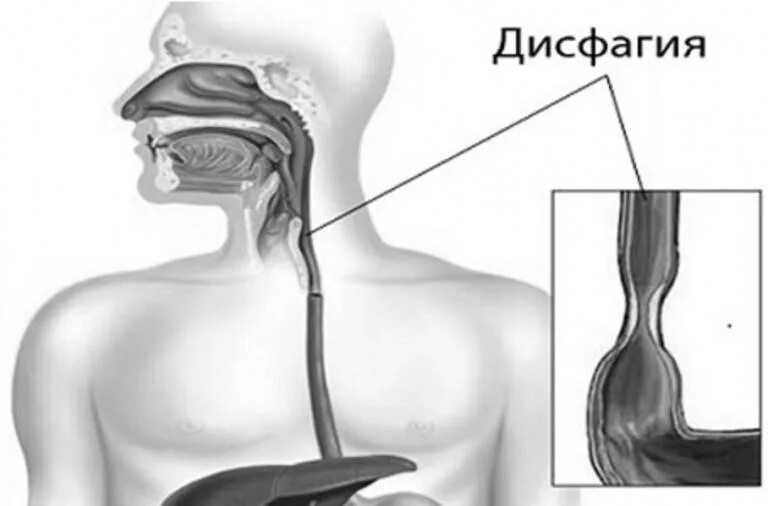 Еда застревает в пищеводе