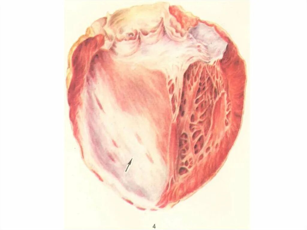 Инфаркт миокарда рубец. ИБС диффузный кардиосклероз. Постинфарктный кардиосклероз. Мелкоочаговый кардиосклероз.
