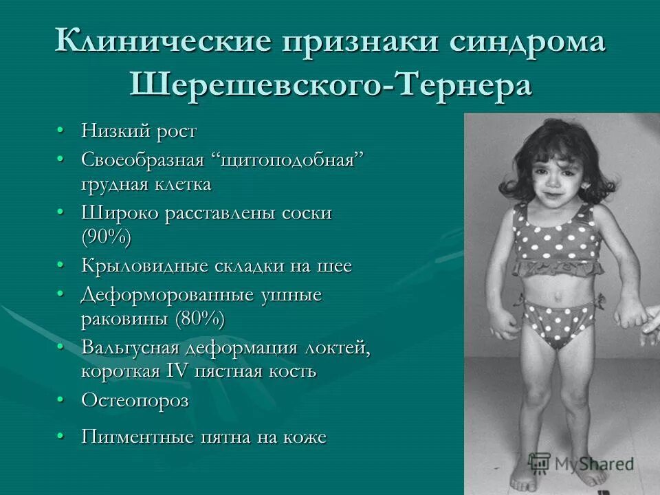 Рост генетических заболеваний. Генетическое заболевание синдром шерешевского тернера. Синдром марфана генная болезнь. Генные болезни особенности клинических проявлений. Причины роста наследственных заболеваний.