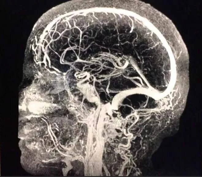 МР-ангиография сосудов головного мозга. Кт ангиография сосудов головного мозга. МР-ангиография интракраниальных сосудов. Мрт головного мозга с ангиографией.