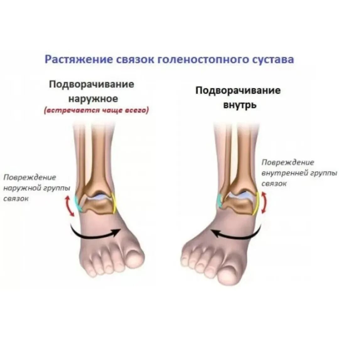 Голеностопный сустав анатомия связки растяжение. Дельтовидная связка голеностопного сустава анатомия. Разрыв связок голеностопного сустава. Сухожилия голеностопного сустава анатомия.