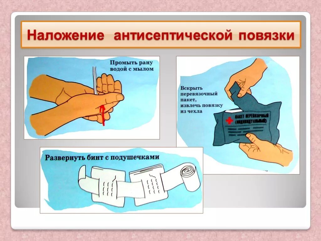 Наложение асептической повязки. Наложение антисептической повязки алгоритм. Наложить асептическую повязку. Способ наложения асептической повязки. Наложение асептической повязки на рану