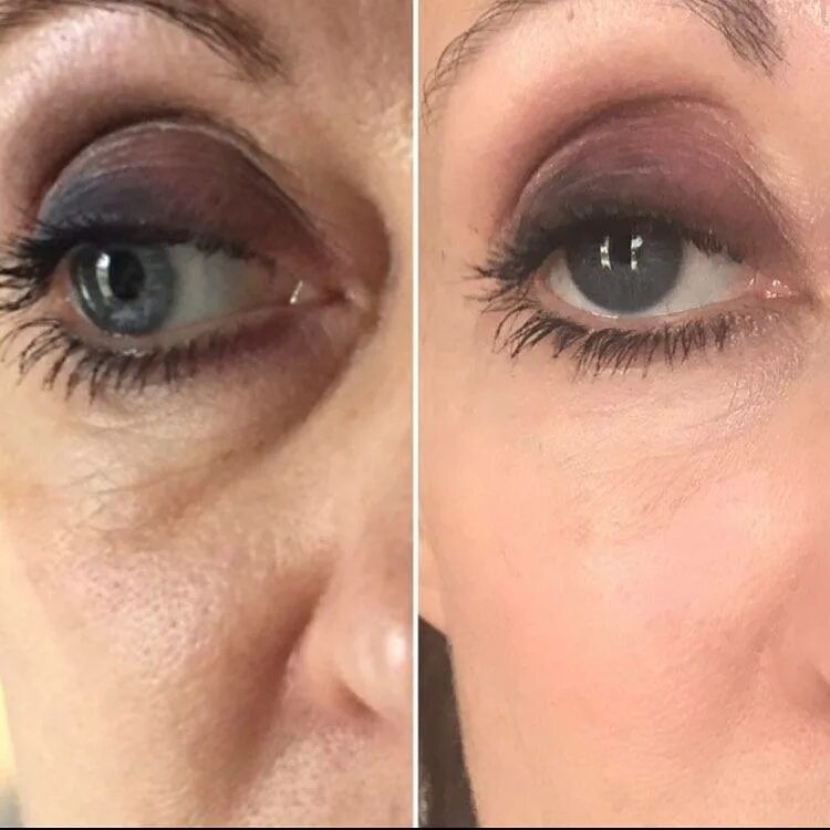 После ботокса глаза как выглядят отечно фото Natural Facelifts At Home: Composition Of A Non-Surgical Facelift Regime. Face R