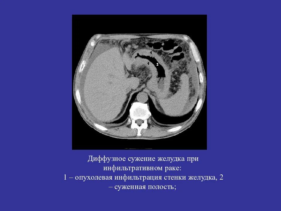 Диффузное утолщение стенок. Инфильтрация стенок желудка кт. СКТ утолщение стенок желудка. "Диффузная инфильтрация желудка".