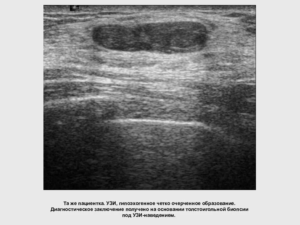 Гипоэхогенное округлое образование. Гипоэхогенное образование мягких тканей на УЗИ. УЗИ гипоэхогенное образование молочной железы. Гипоэхогенное образование в молочной железе на УЗИ. Гипоэхогенные образования молочных желез.