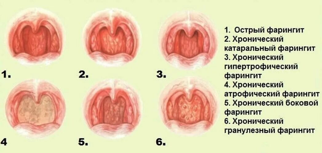 Формы хронического гипертрофического фарингита. Гипертрофический (гранулёзный) фарингит. Хронический фарингит факторы. Гипертрофический ларингит.