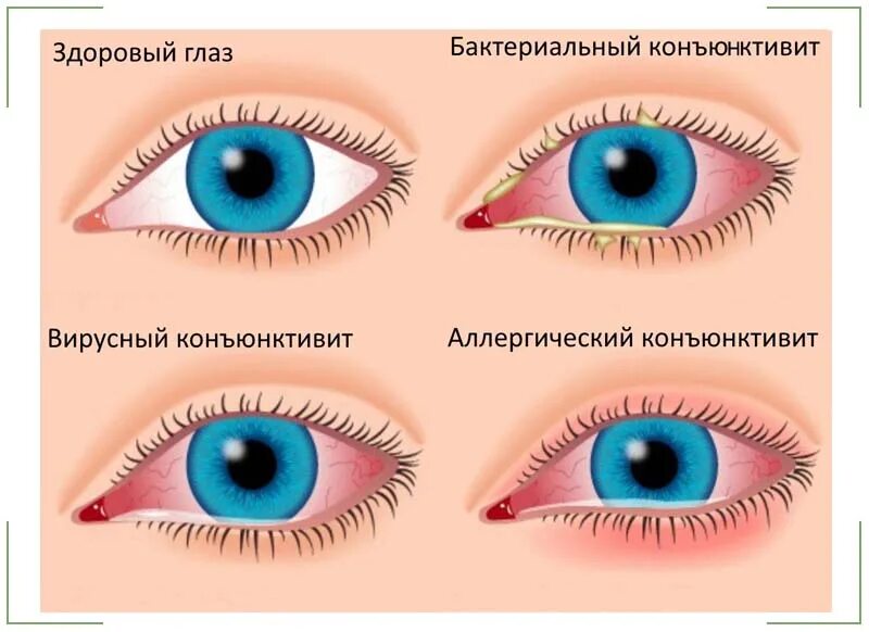 Можно ли вылечить конъюнктивит. Осложнения конъюнктивита. профилактика конъюнктивита у детей. бактериальный и аллергический конъюнктивит. вирусный конъюнктивит у детей.