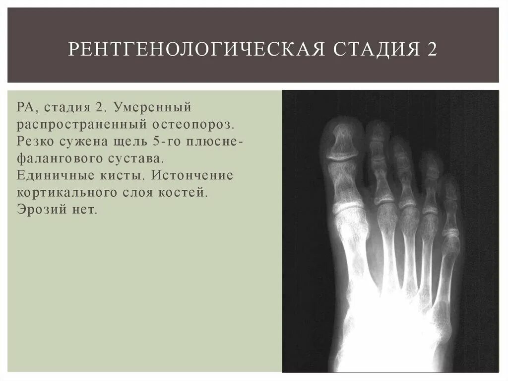 Артрит рентгенологические стадии. Подагрический артрит 1 пальца стопы рентген. Ревматоидный артрит кисти рентген. Для 2 рентгенологической стадии артрита. Ревматоидный артрит 1 стадия на рентгене.
