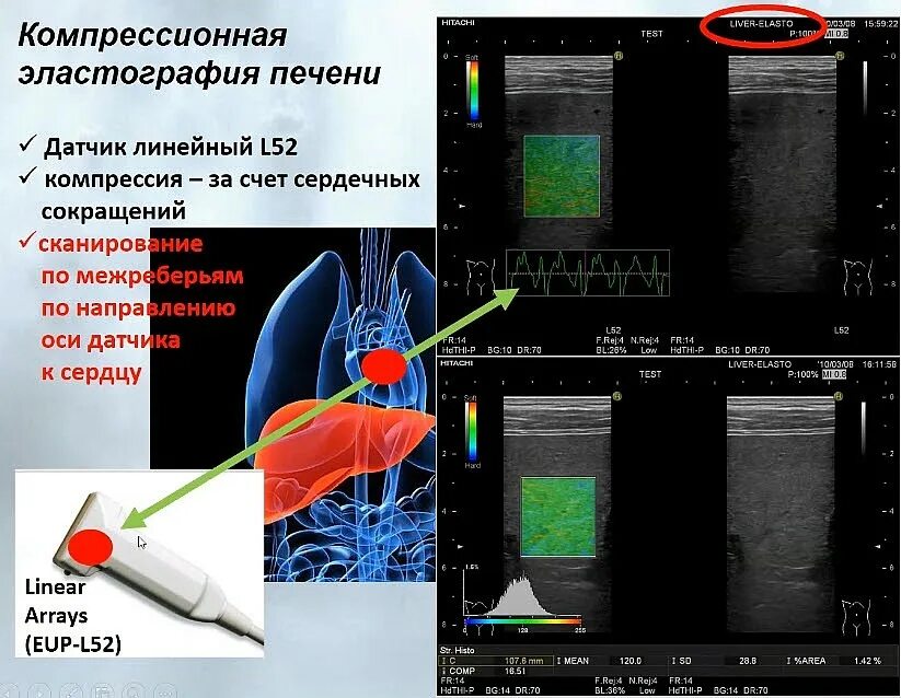 Эластография сдвиговой волны. Непрямая ультразвуковая эластография печени. Компрессионная эластография щитовидной железы. Транзиентная эластография.