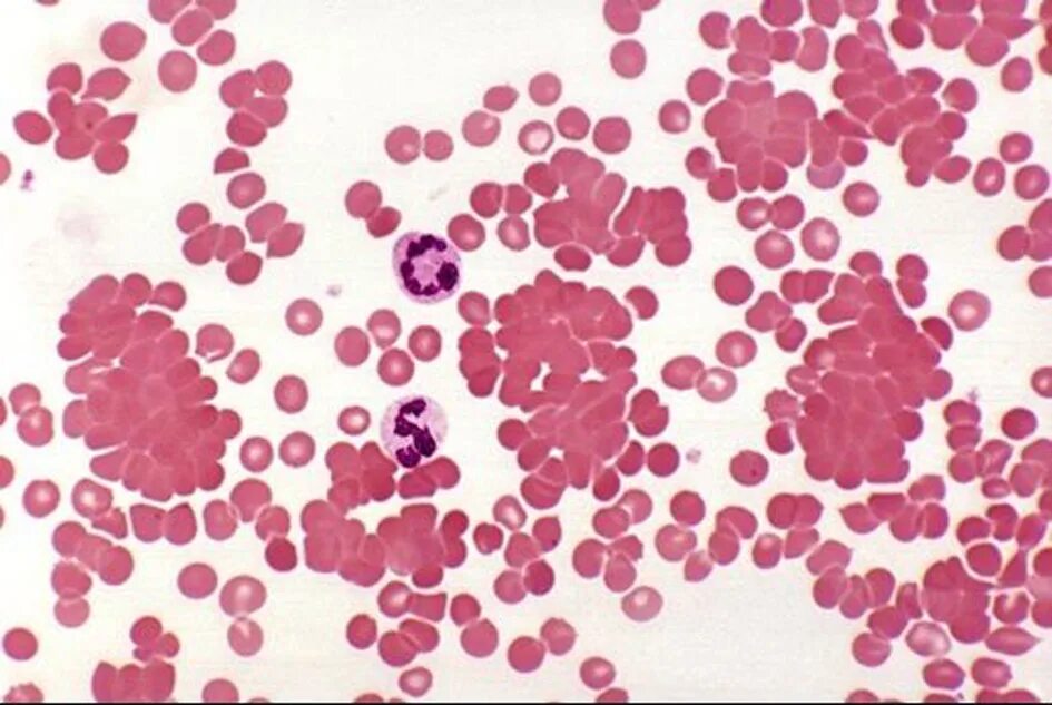 Гемолитическая анемия мазок крови. Аутоиммунная гемолитическая анемия мазок крови. Аутоиммунная гемолитическая анемия мазок. Гистология аутоиммунной гемолитической анемии. Малокровие 6