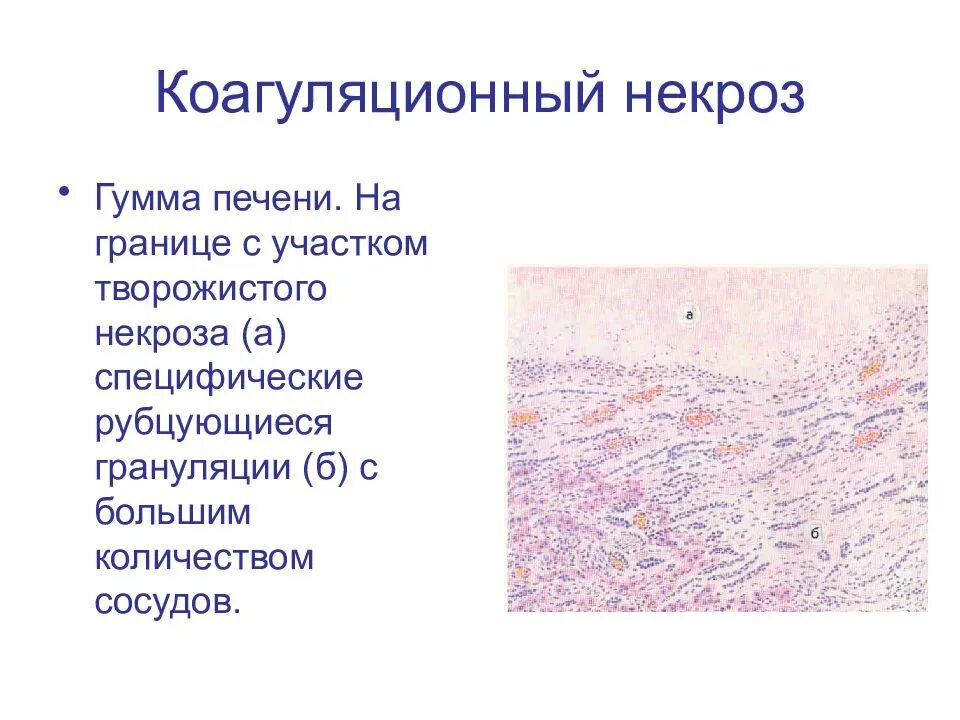 Коагуляционный некроз гистология. Колликвационный некроз клетки. Коагуляционный (сухой) некроз. Коагуляционный некроз причины.