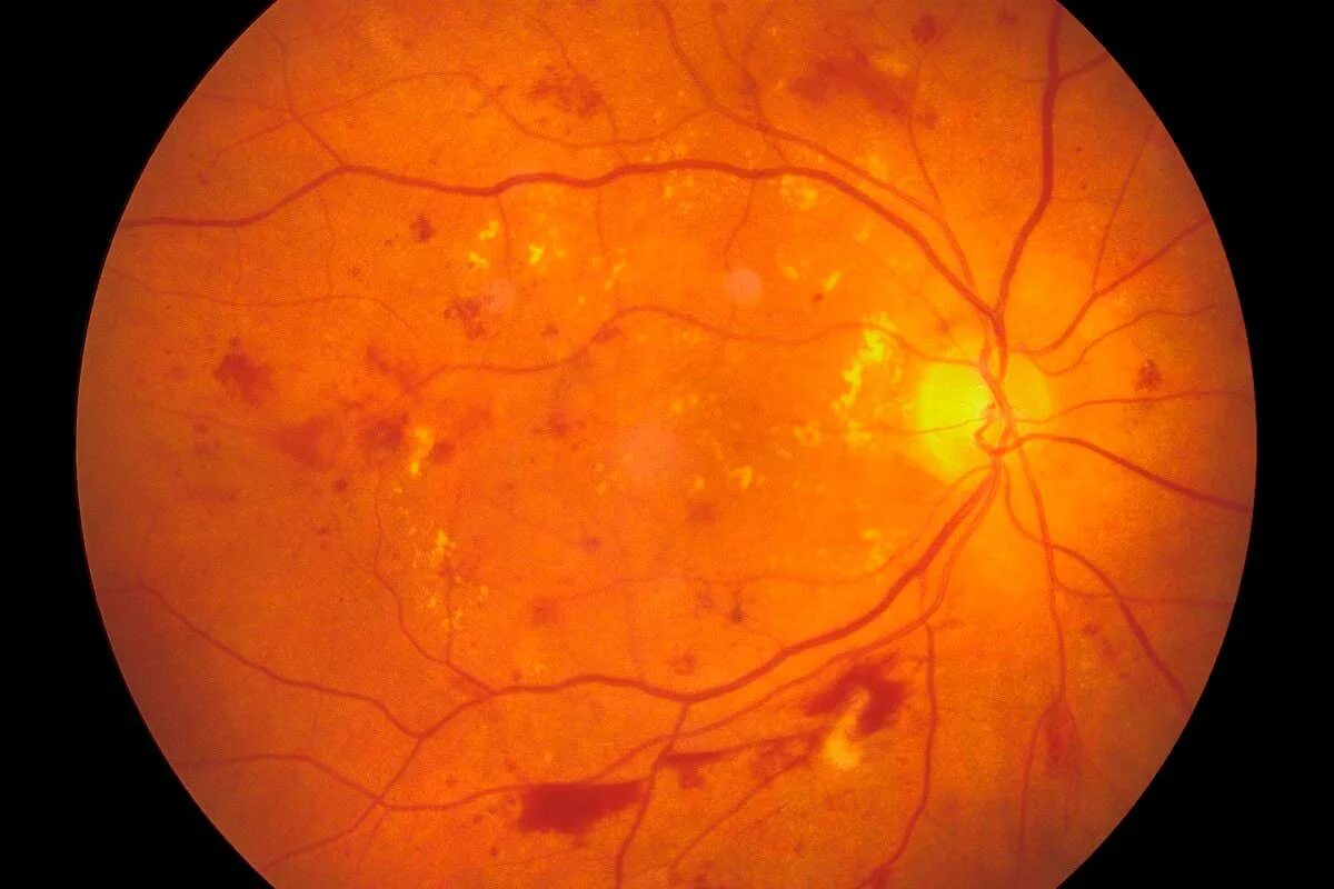 Болезнь глазного дна. Макулярная ретинопатия. Диабетический макулярный отек. Непролиферативная ретинопатия. Непролиферативная диабетической ретинопатии.